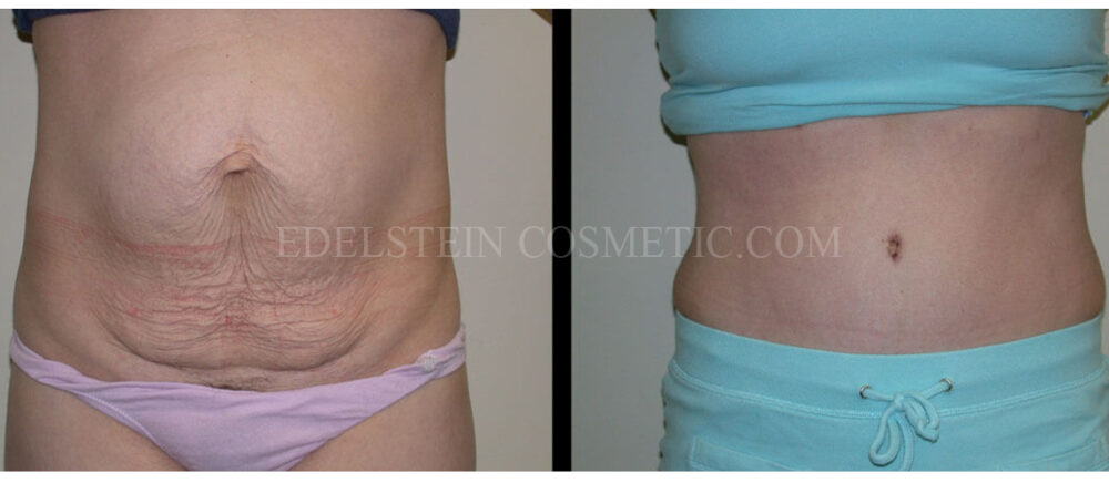 Tummy Tuck case #26634