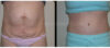 Tummy Tuck case #26634 slider thumbnail