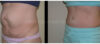 Tummy Tuck case #26634 slider thumbnail