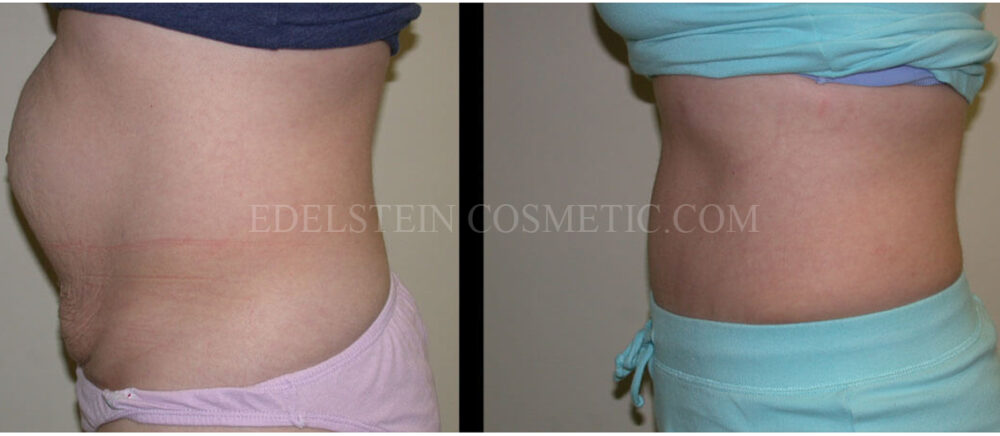 Tummy Tuck case #26634