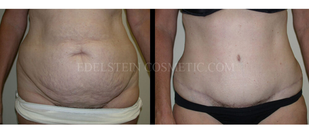 Tummy Tuck case #26633