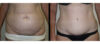 Tummy Tuck case #26633 slider thumbnail