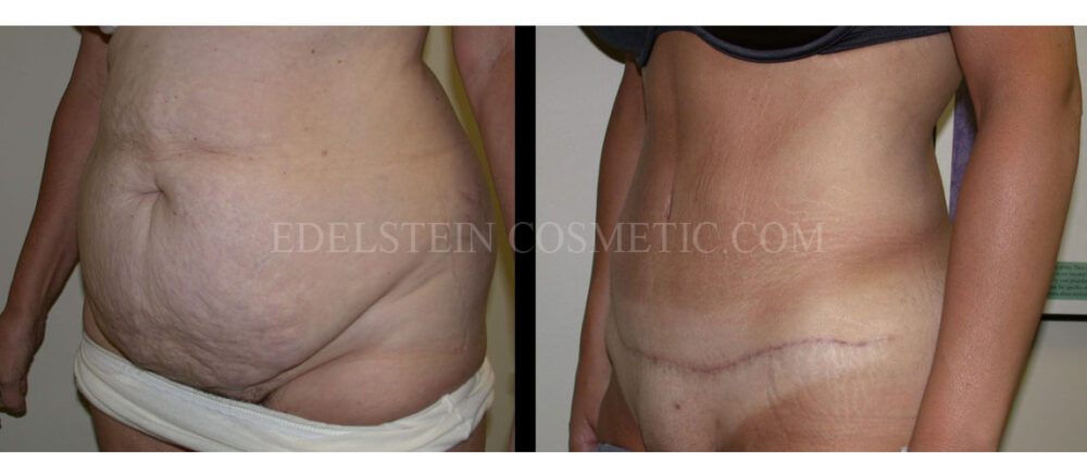 Tummy Tuck case #26633