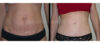 Tummy Tuck case #26632 slider thumbnail