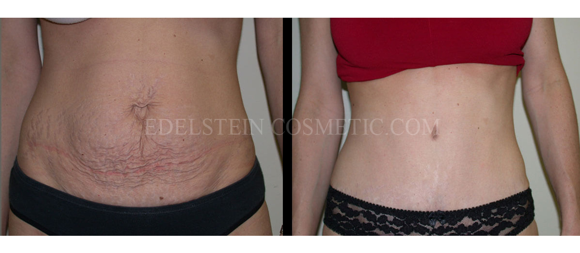 Tummy Tuck case #26632