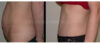 Tummy Tuck case #26632 slider thumbnail