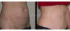 Tummy Tuck case #26632 slider thumbnail