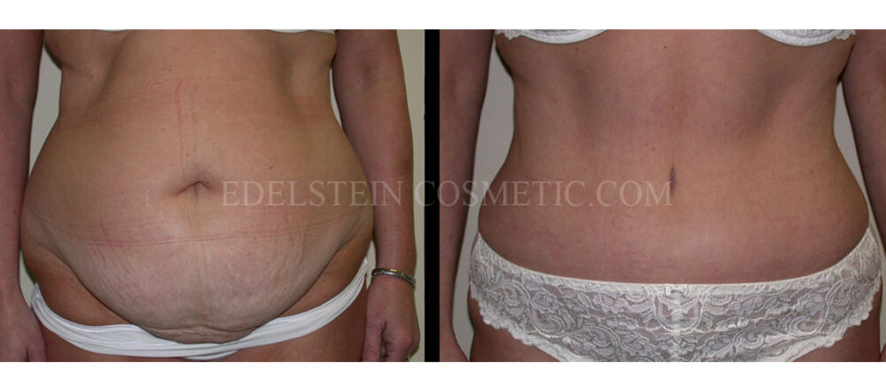 Tummy Tuck case #26631