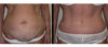 Tummy Tuck case #26631 slider thumbnail