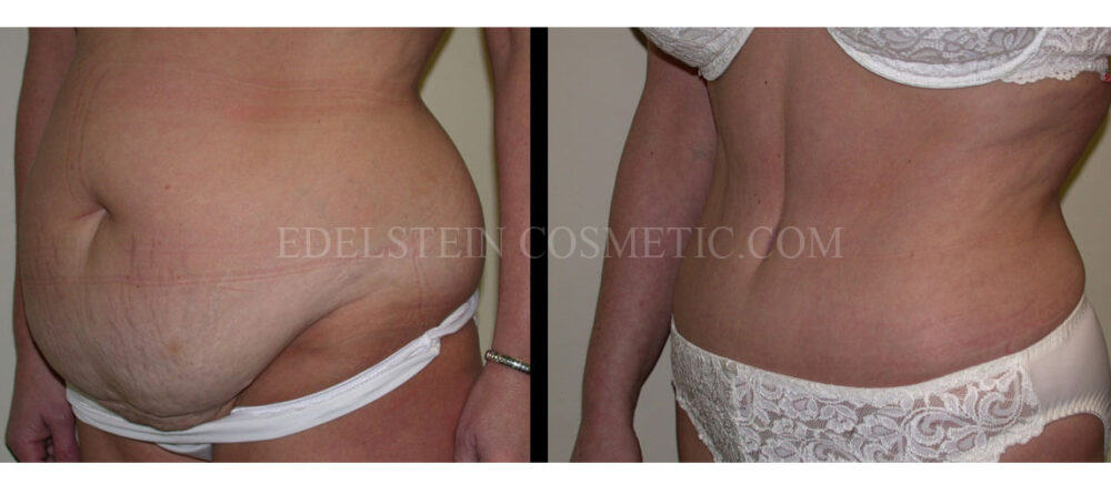 Tummy Tuck case #26631