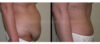 Tummy Tuck case #26631 slider thumbnail