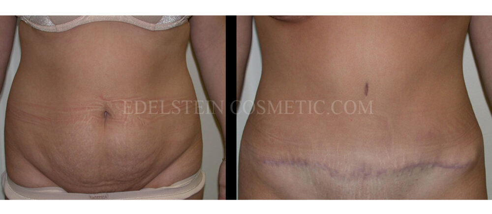 Tummy Tuck case #26630