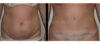 Tummy Tuck case #26630 slider thumbnail