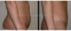 Tummy Tuck case #26630 slider thumbnail