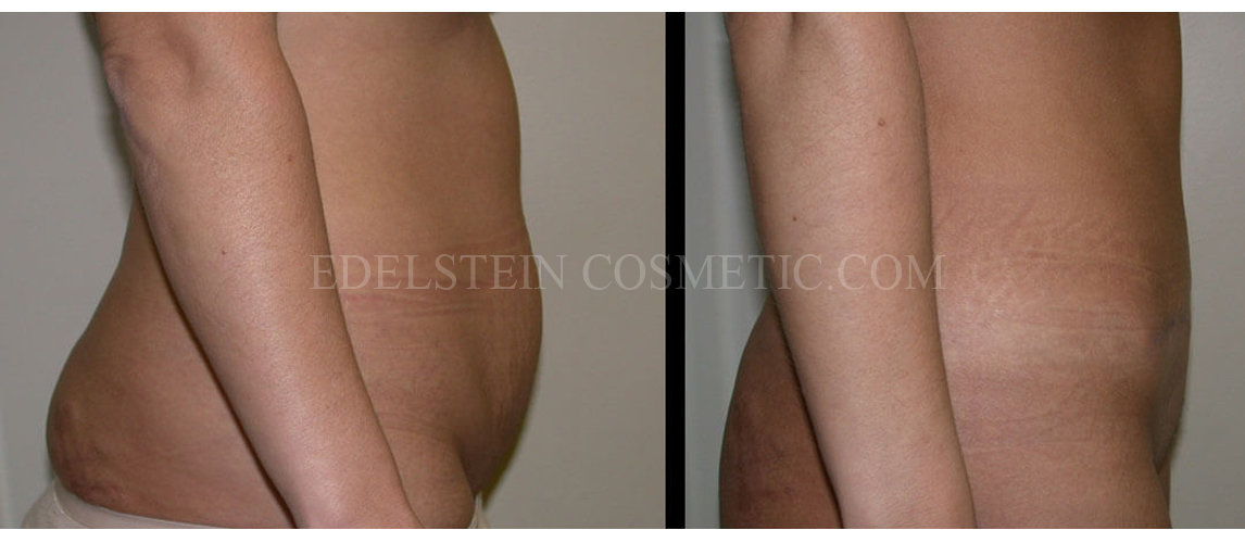 Tummy Tuck case #26630