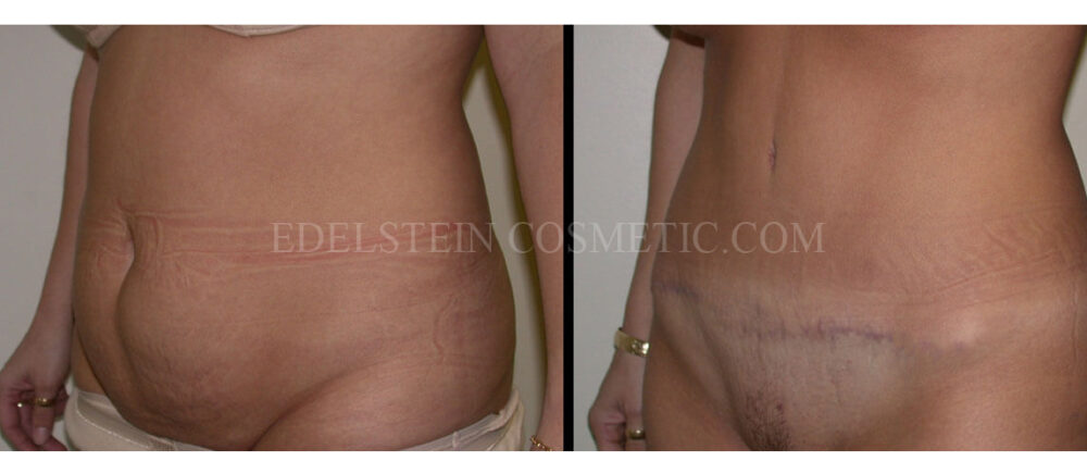 Tummy Tuck case #26630