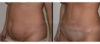 Tummy Tuck case #26630 slider thumbnail