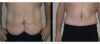 Tummy Tuck case #26629 slider thumbnail