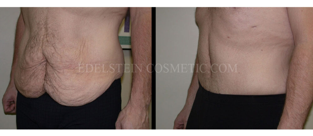 Tummy Tuck case #26629