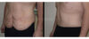 Tummy Tuck case #26629 slider thumbnail