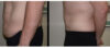 Tummy Tuck case #26629 slider thumbnail