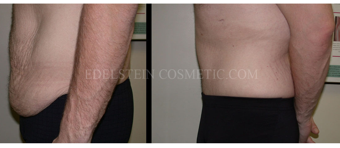 Tummy Tuck case #26629