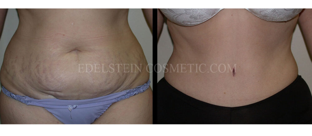 Tummy Tuck case #26628