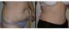 Tummy Tuck case #26628 slider thumbnail