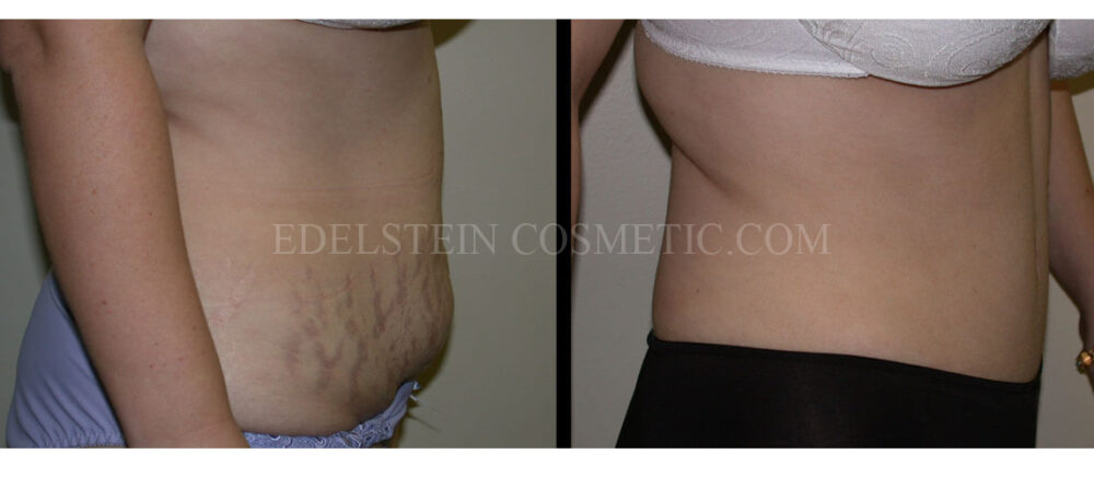 Tummy Tuck case #26628