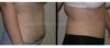 Tummy Tuck case #26628 slider thumbnail