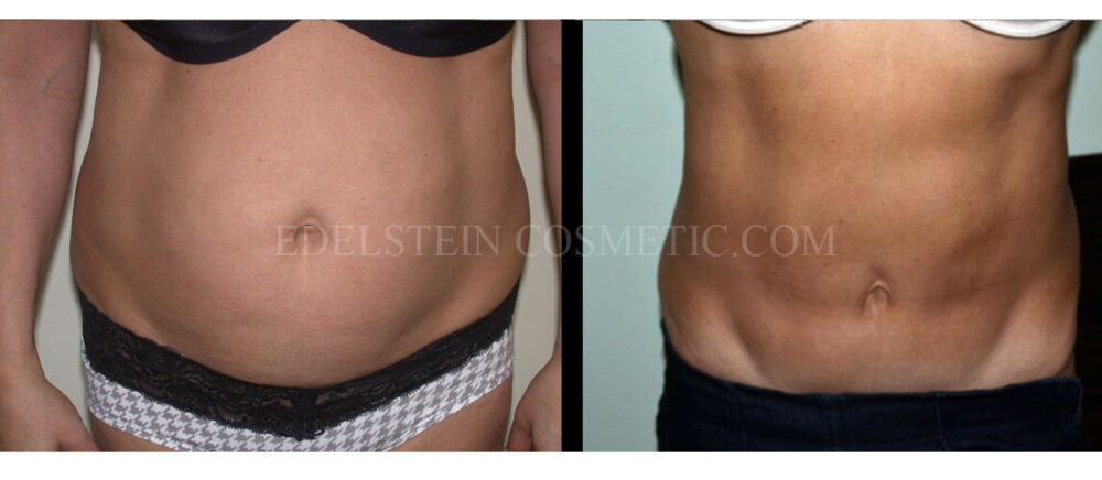 Tummy Tuck case #26627