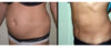 Tummy Tuck case #26627 slider thumbnail