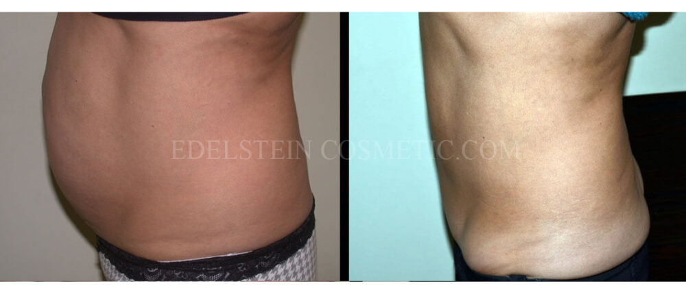 Tummy Tuck case #26627