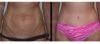 Tummy Tuck case #26626 slider thumbnail