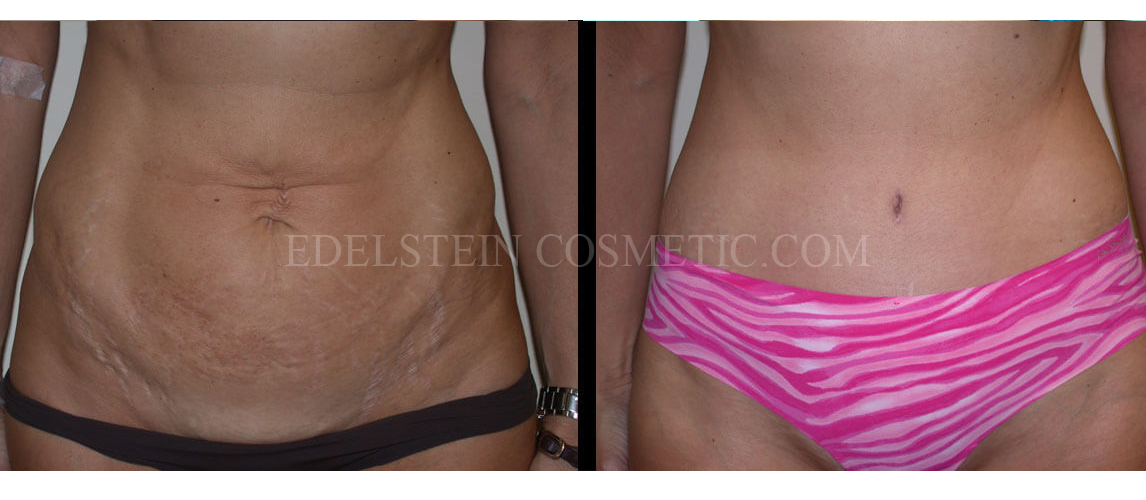 Tummy Tuck case #26626