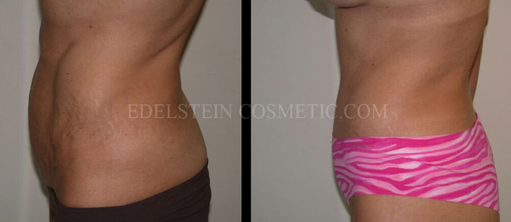 Tummy Tuck case #26626