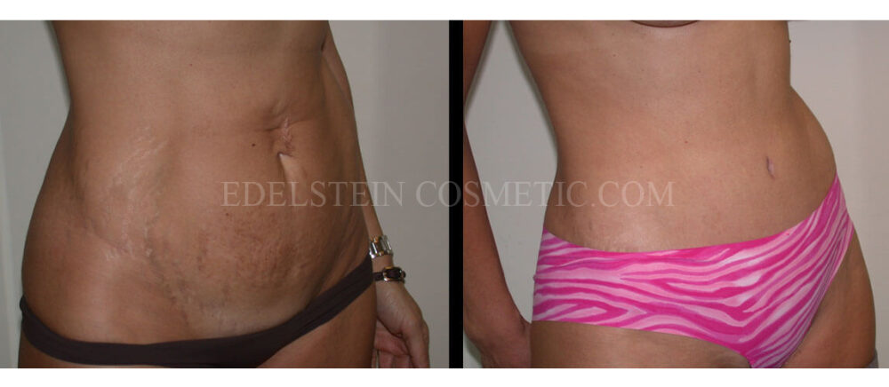 Tummy Tuck case #26626