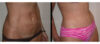 Tummy Tuck case #26626 slider thumbnail