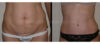 Tummy Tuck case #26625 slider thumbnail