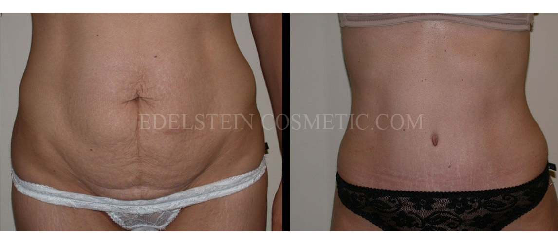 Tummy Tuck case #26625