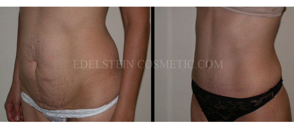 Tummy Tuck case #26625