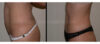 Tummy Tuck case #26625 slider thumbnail