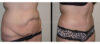 Tummy Tuck case #26624 slider thumbnail