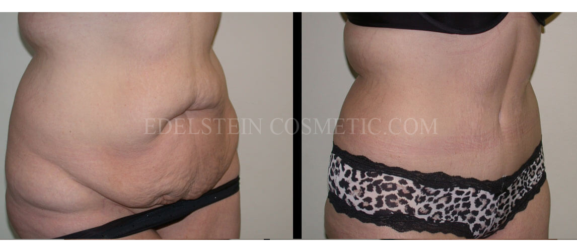 Tummy Tuck case #26624