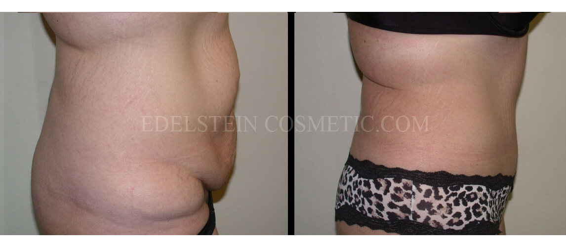 Tummy Tuck case #26624