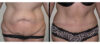 Tummy Tuck case #26624 slider thumbnail