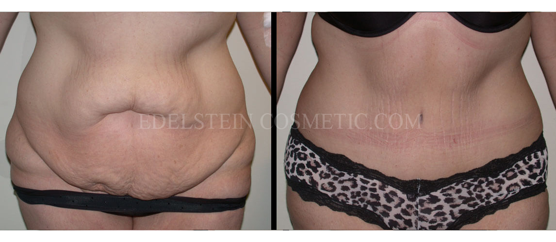 Tummy Tuck case #26624