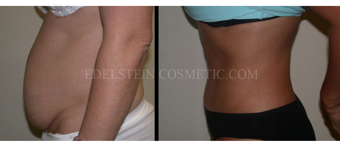 Tummy Tuck case #26623