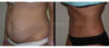 Tummy Tuck case #26623 slider thumbnail