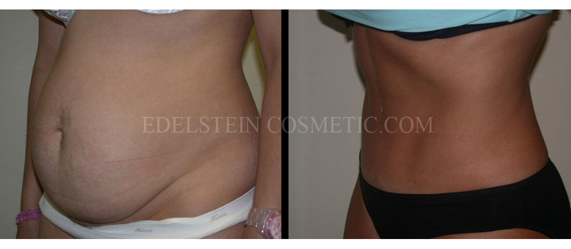 Tummy Tuck case #26623